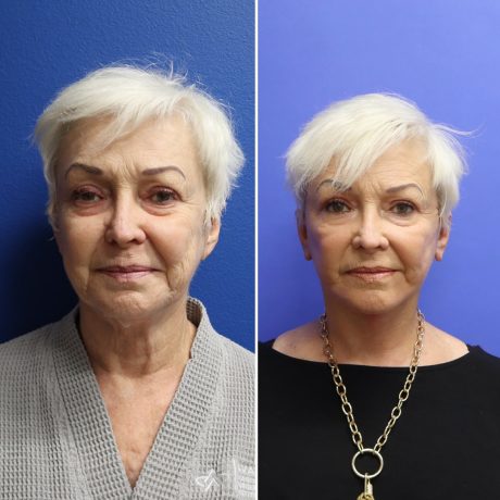 Before and After - Face & Neck