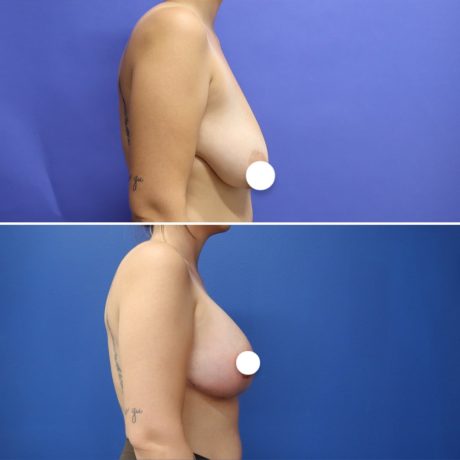 Before and After - Elevación de pecho con implantes (Mastopexia de aumento)