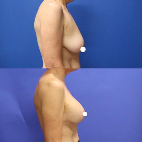 Before and After - Elevación de pecho con implantes (Mastopexia de aumento)