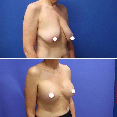 Before and After - Elevación de pecho con implantes (Mastopexia de aumento)