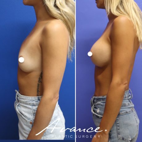 Before and After - Breast Augmentation