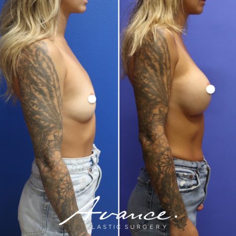 Before and After - Breast Augmentation