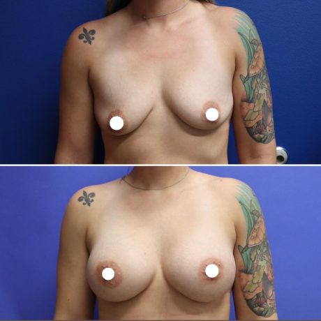 Before and After - Breast Augmentation