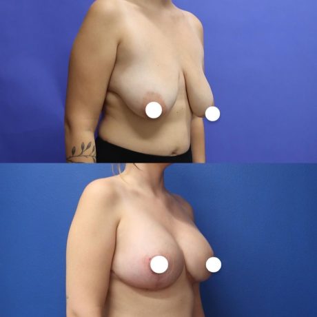 Before and After - Elevación de pecho con implantes (Mastopexia de aumento)