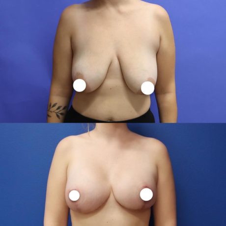 Before and After - Elevación de pecho con implantes (Mastopexia de aumento)