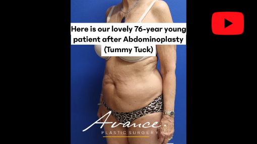 Reno NV Tummy Tuck / Abdominoplasty | Dr. Erez Dayan | Avance Plastic Surgery
