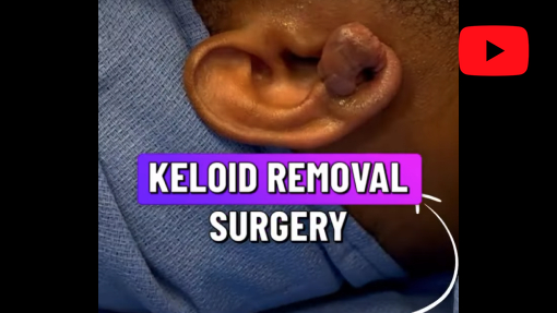 YouTube video titled Ear Keloid Removal | Avance Plastic Surgery Institute: Dr. Erez Dayan | Reno, NV