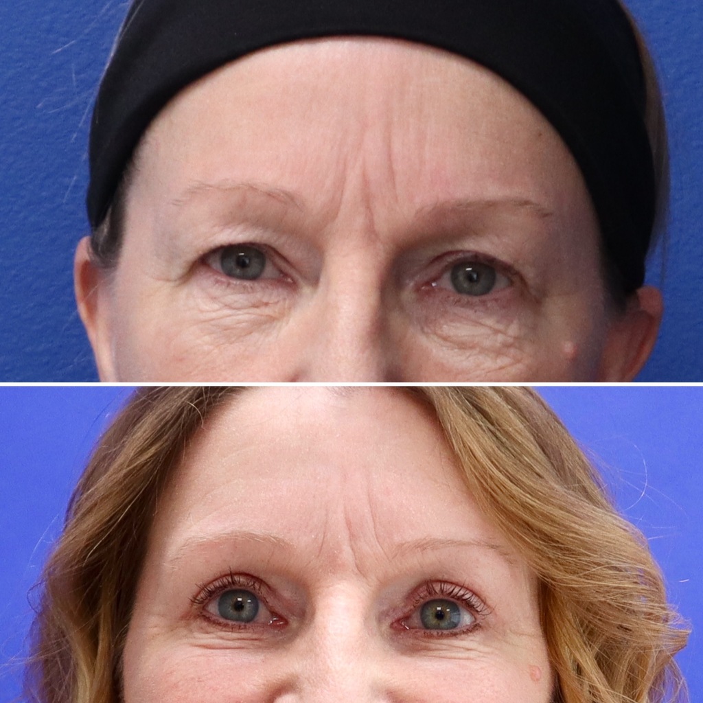 Before and After - Blefaroplastia superior