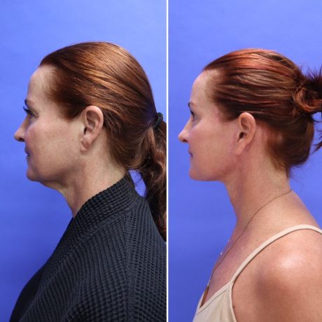 Before and After - Face & Neck