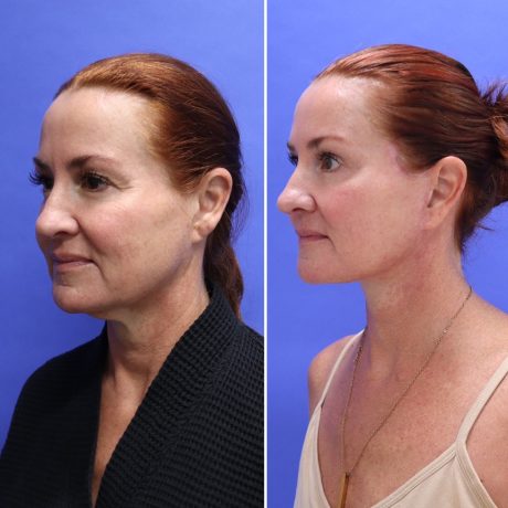 Before and After - Face & Neck