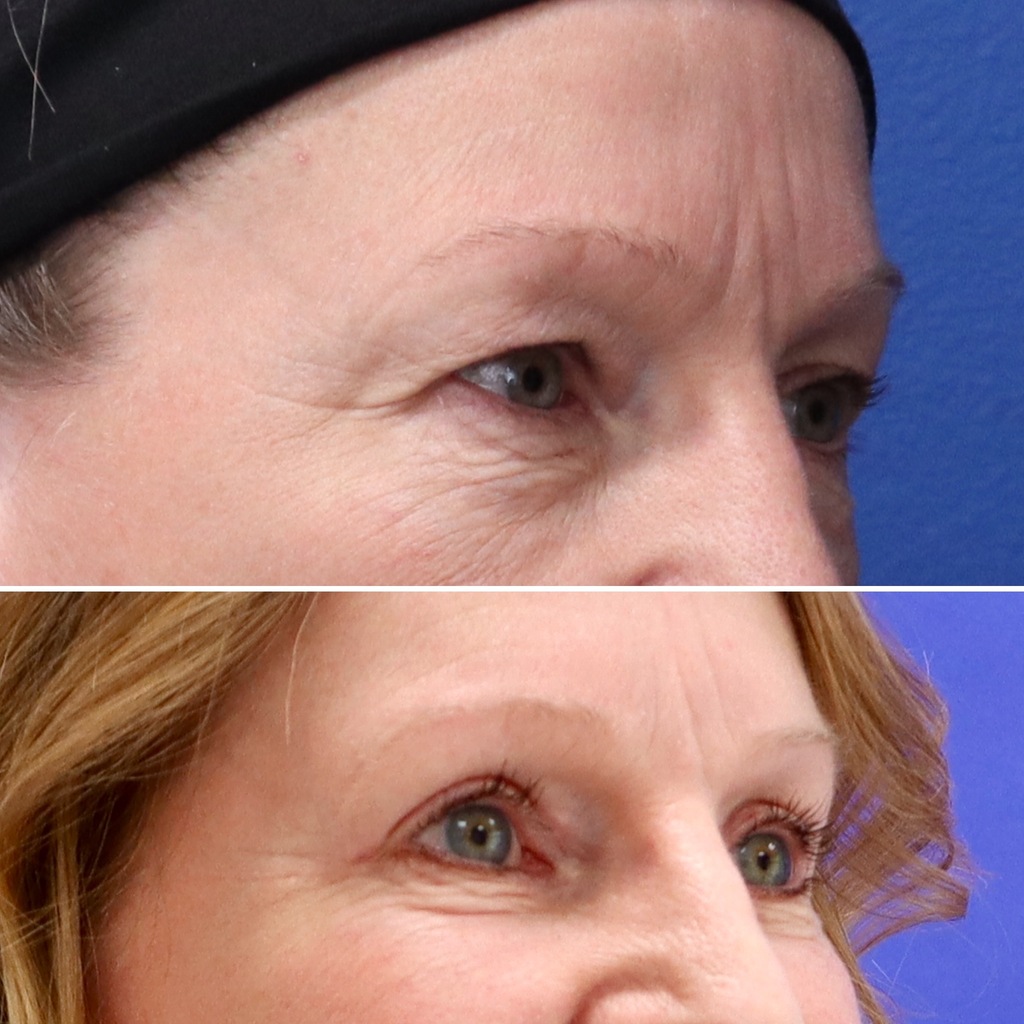 Before and After - Blefaroplastia superior