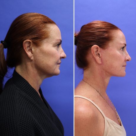 Before and After - Face & Neck