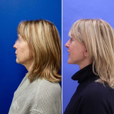 Before and After - Face & Neck