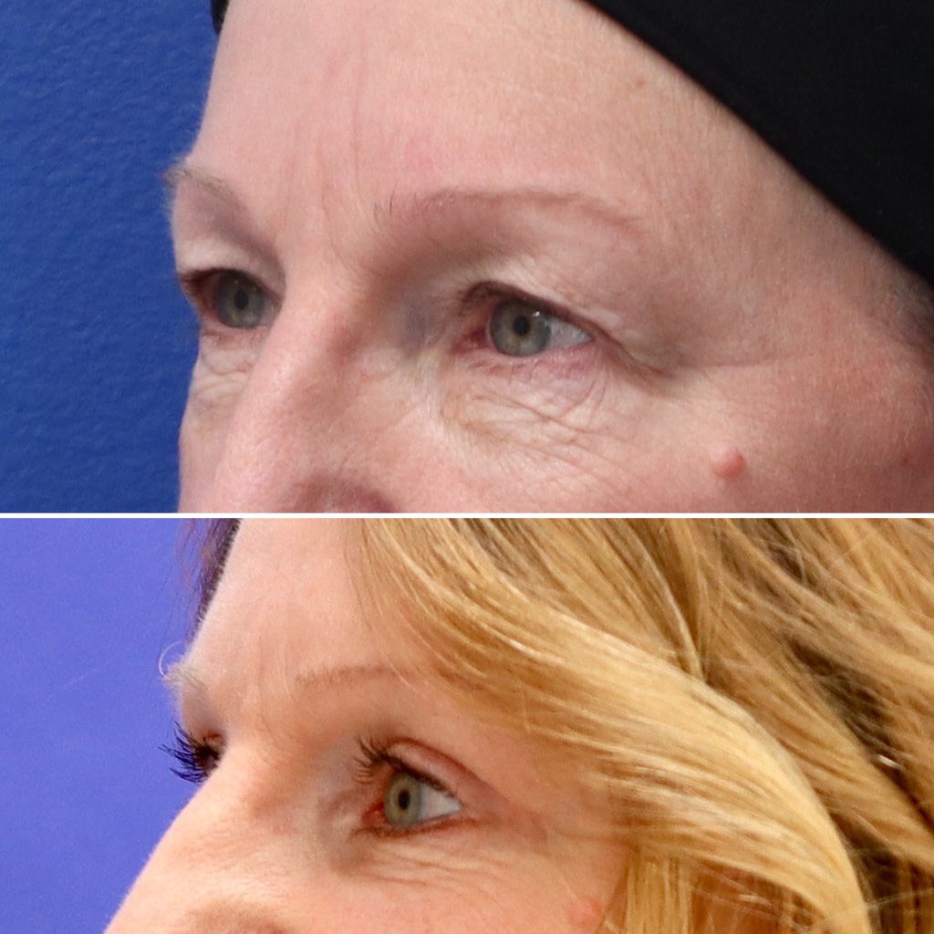 Before and After - Upper Blepharoplasty