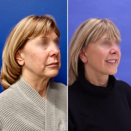 Before and After - Face & Neck