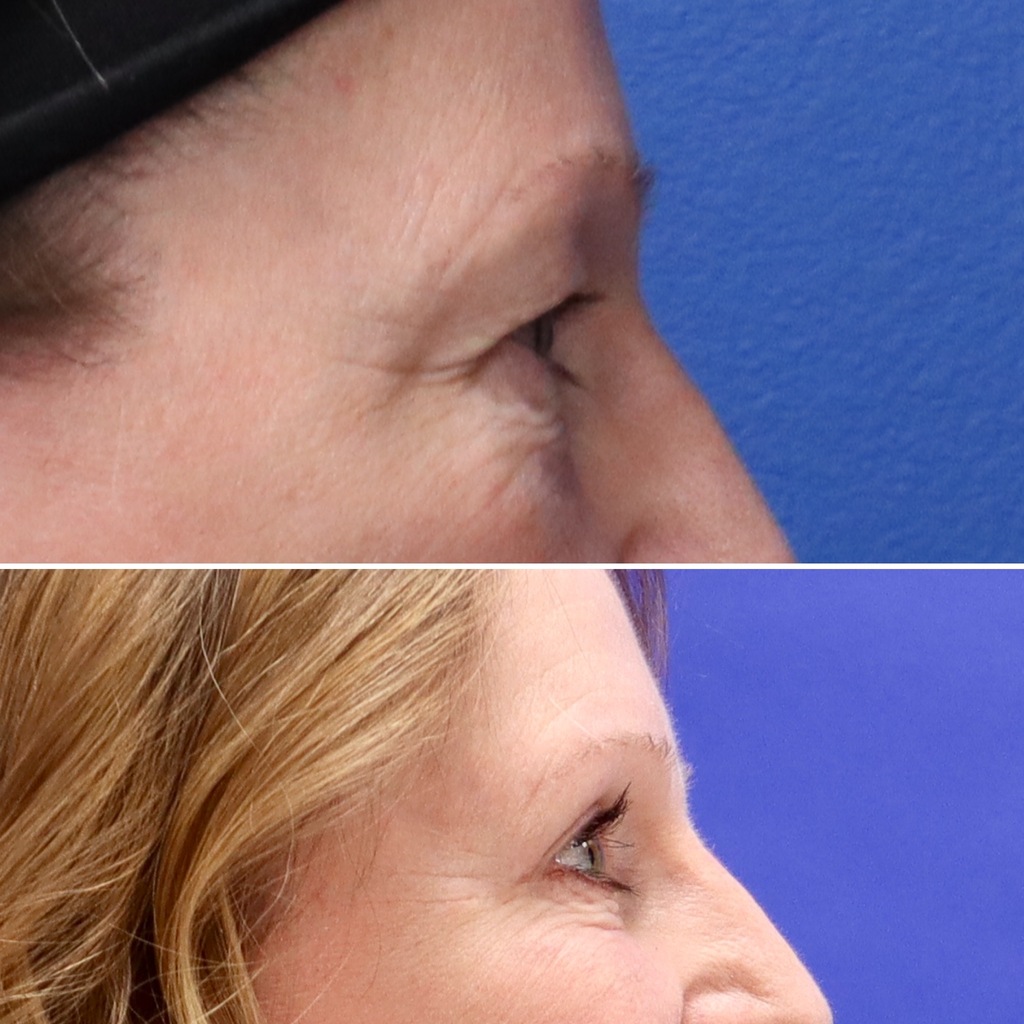 Before and After - Upper Blepharoplasty