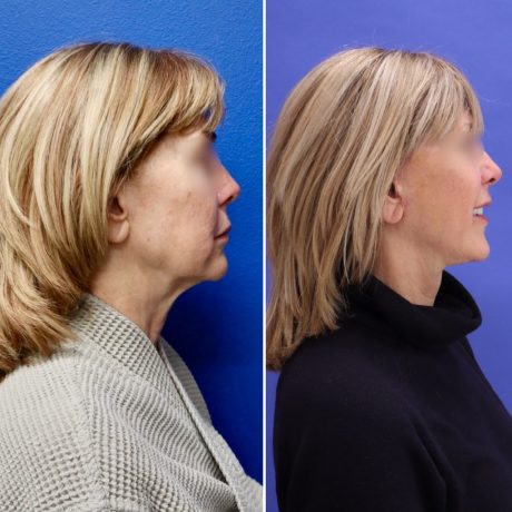 Before and After - Face & Neck