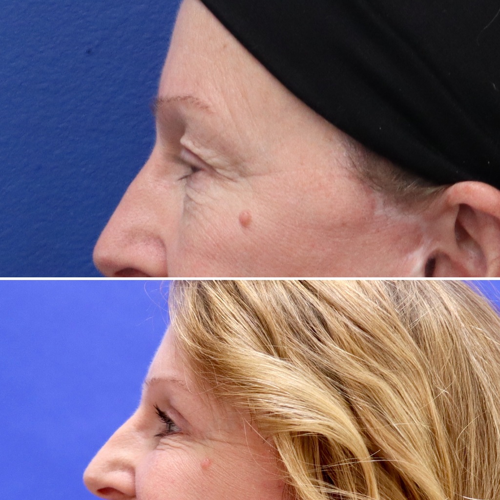 Before and After - Blefaroplastia superior