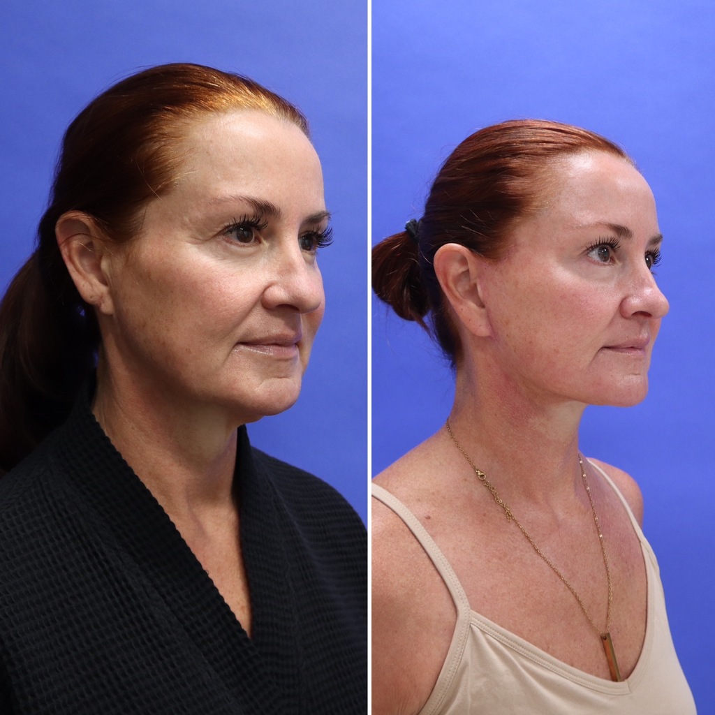 Before and After - Mini Face/Necklift