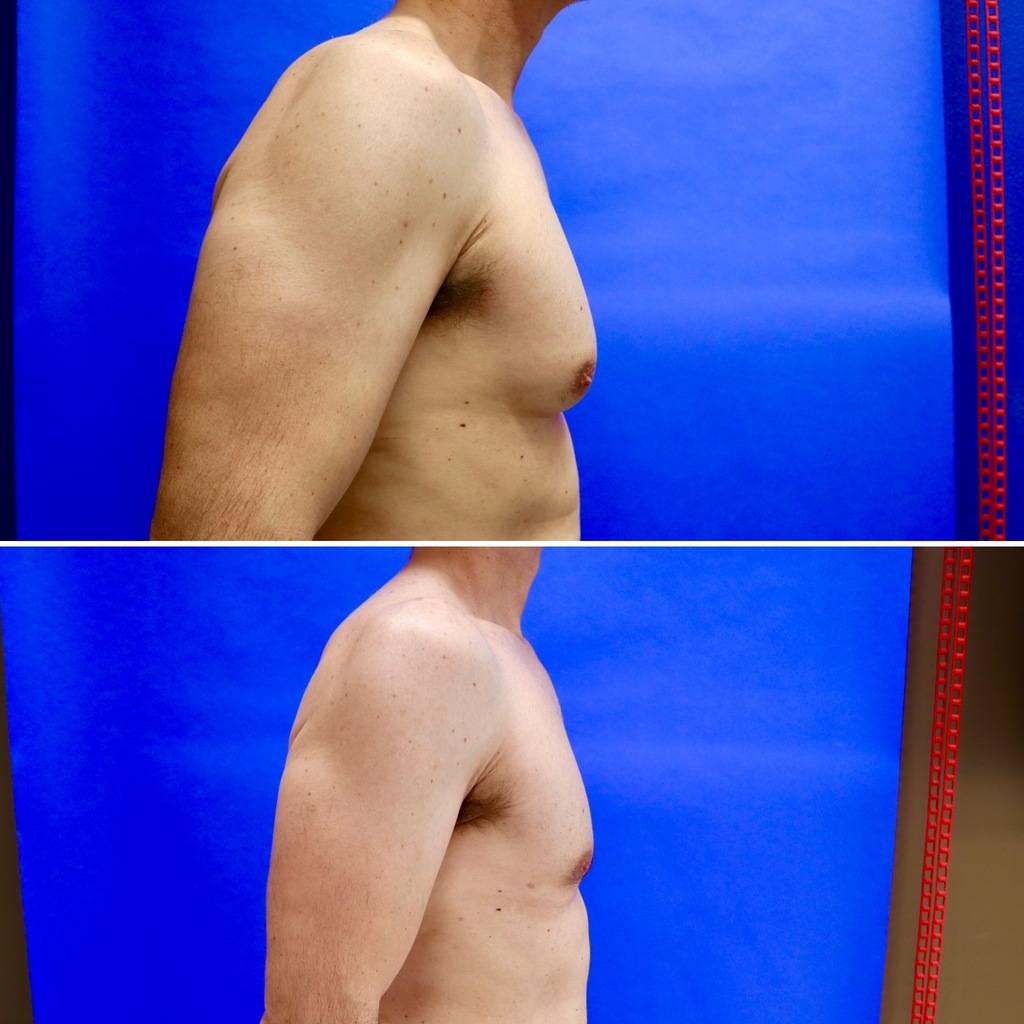 Before and After - Gynecomastia (Male Breast Reduction)