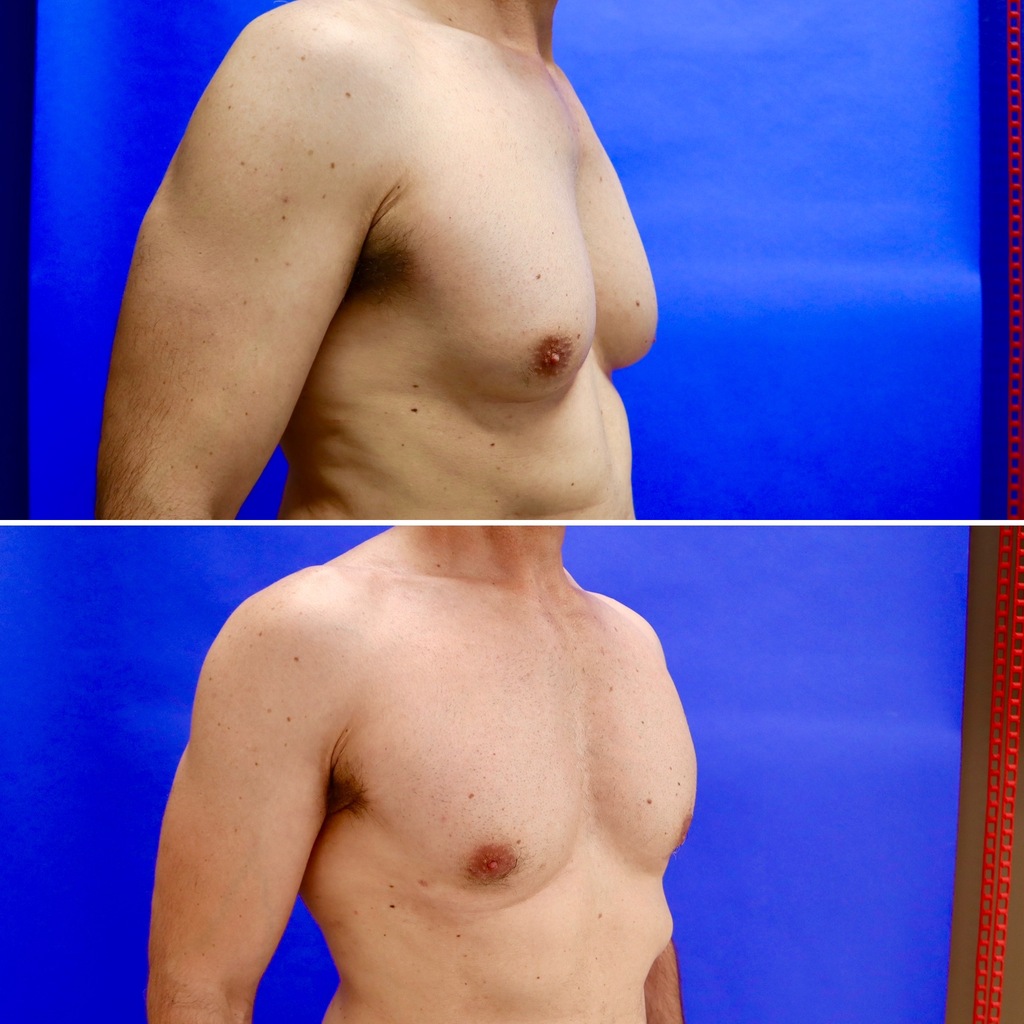 Before and After - Gynecomastia (Male Breast Reduction)