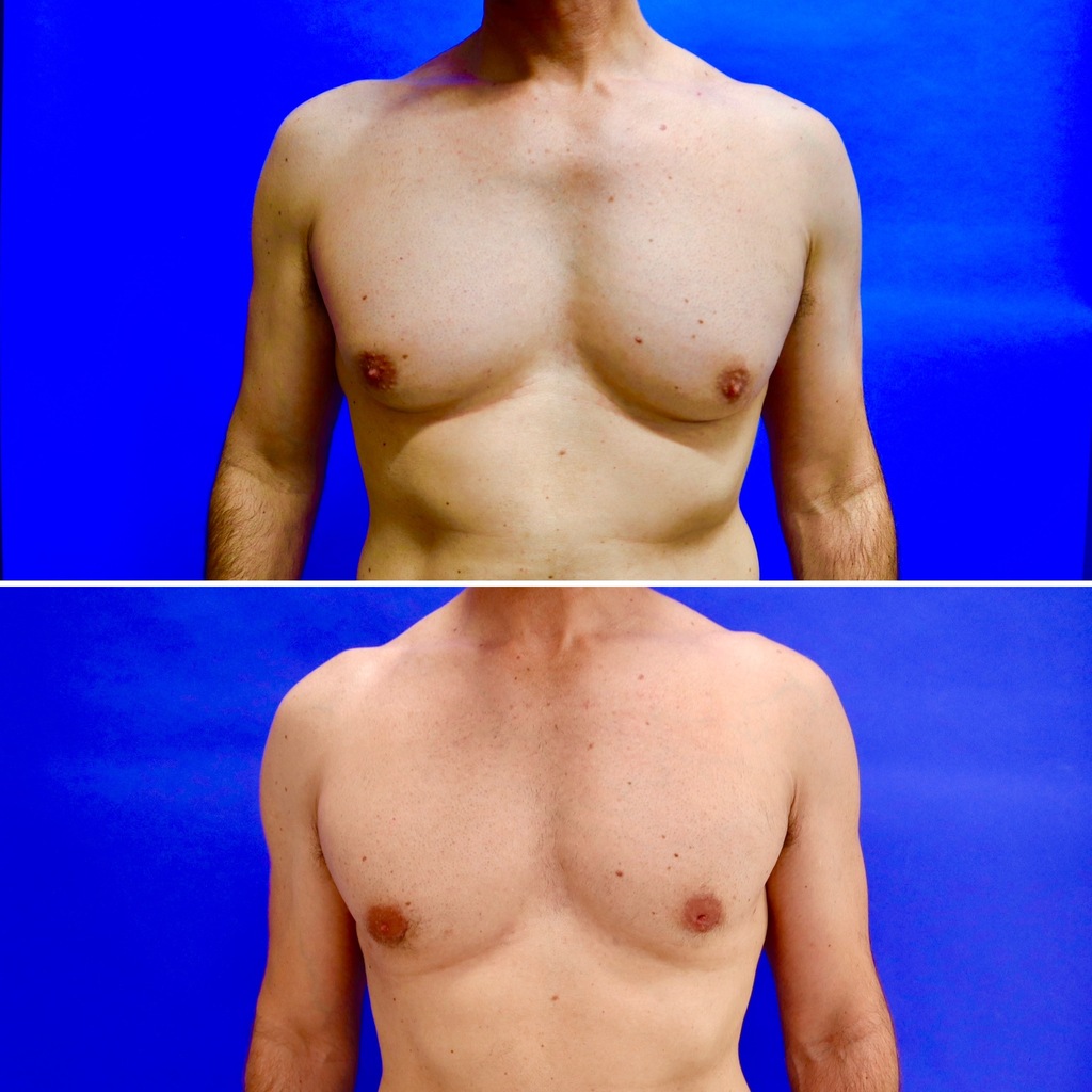 Before and After - Gynecomastia (Male Breast Reduction)