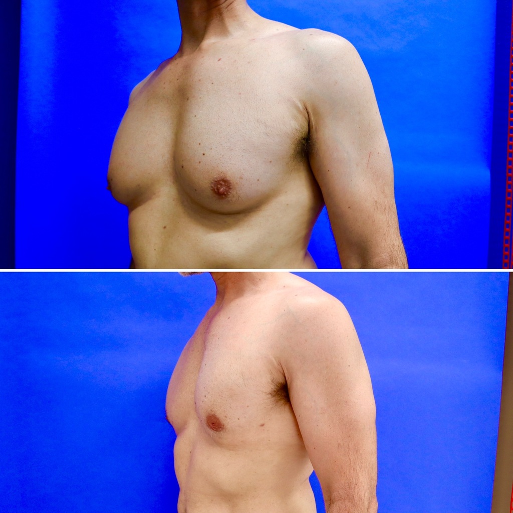 Before and After - Gynecomastia (Male Breast Reduction)