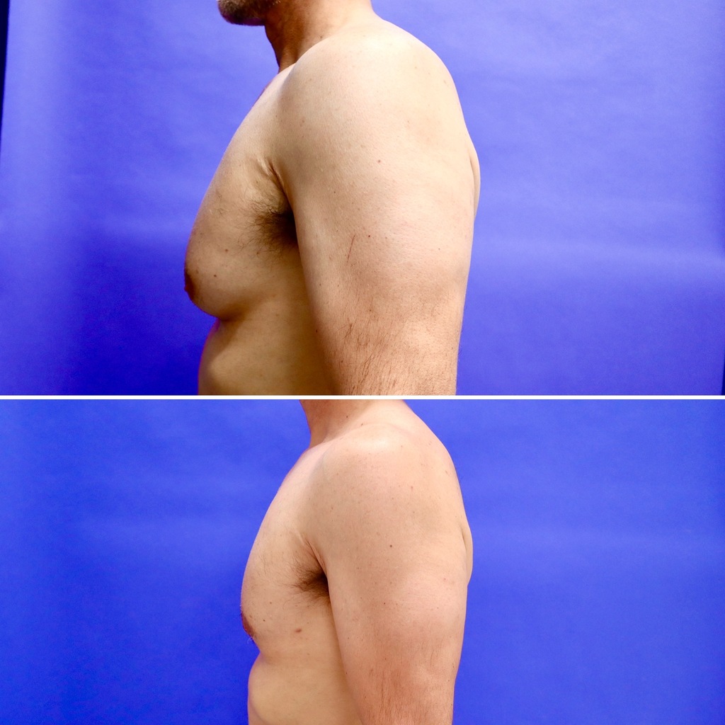 Before and After - Gynecomastia (Male Breast Reduction)