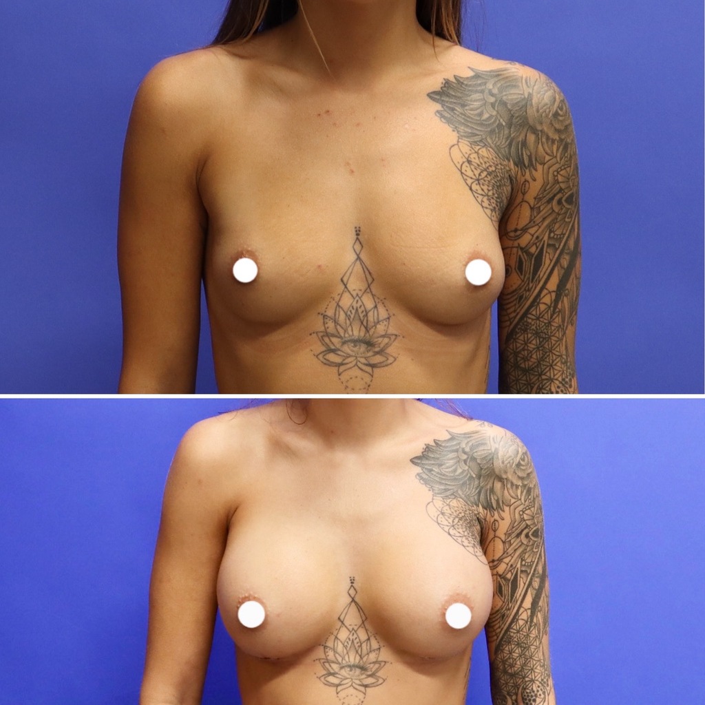 Before and After - Breast Augmentation