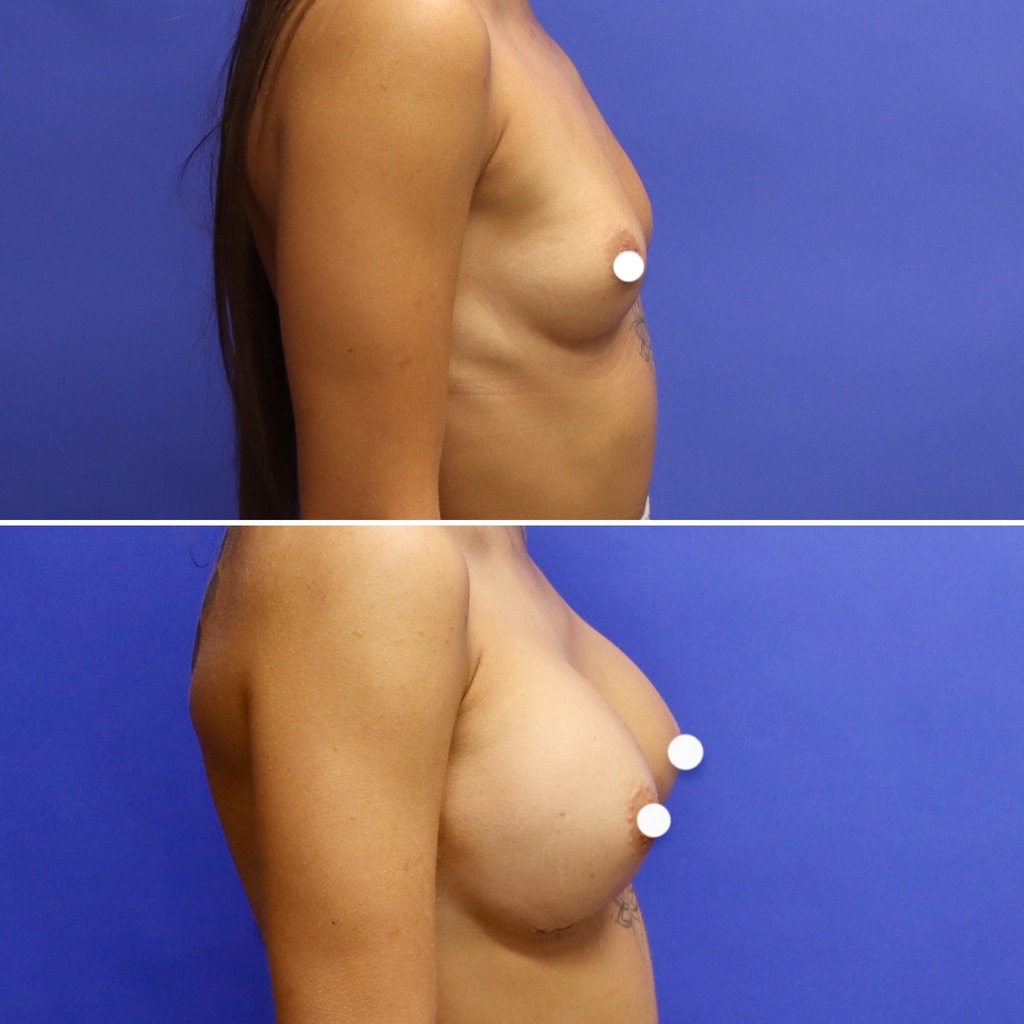 Before and After - Breast Augmentation