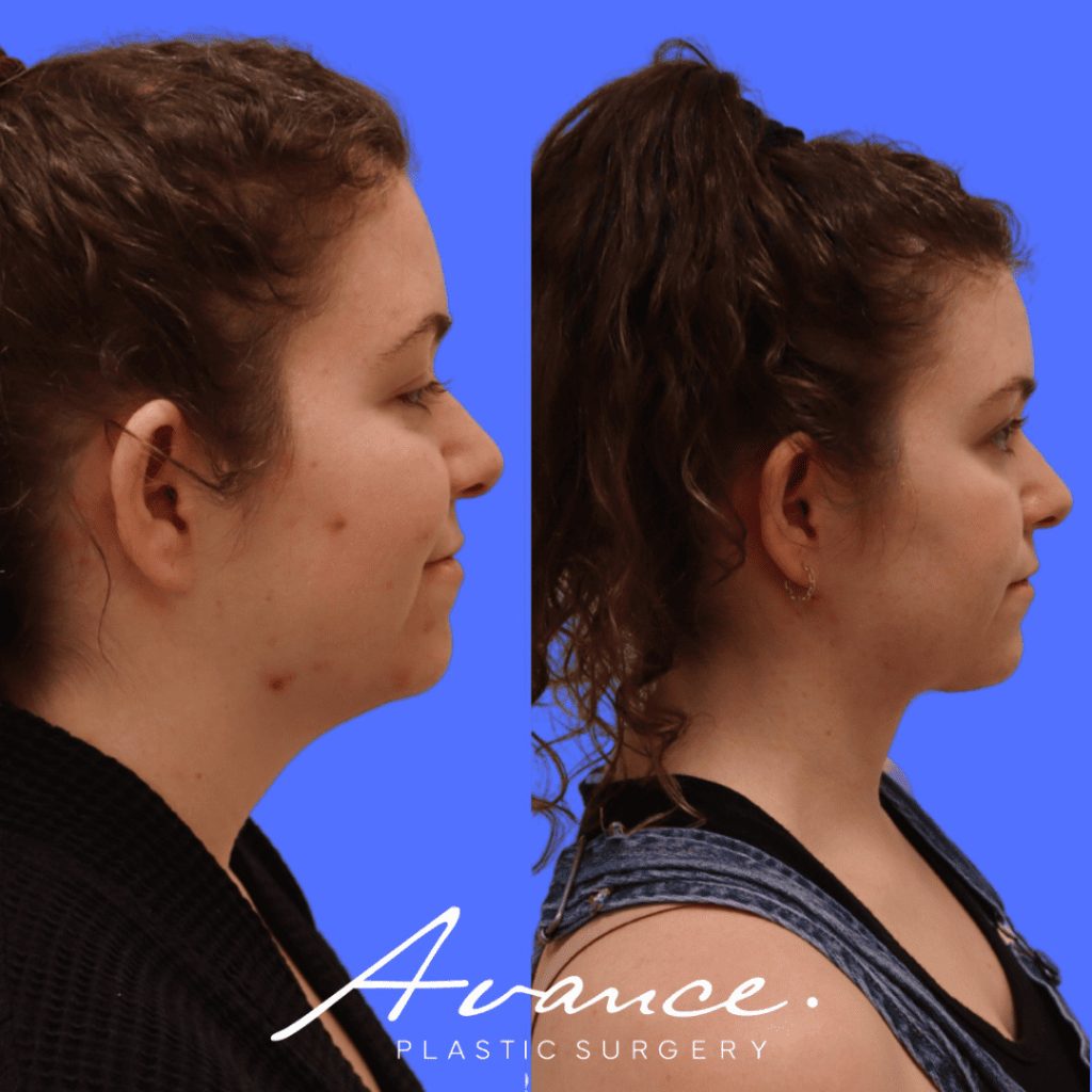 Before and After - Neck Liposuction