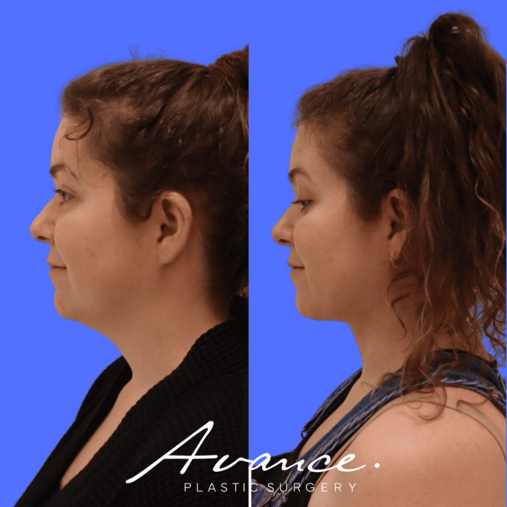 Before and After - Liposucción de cuello