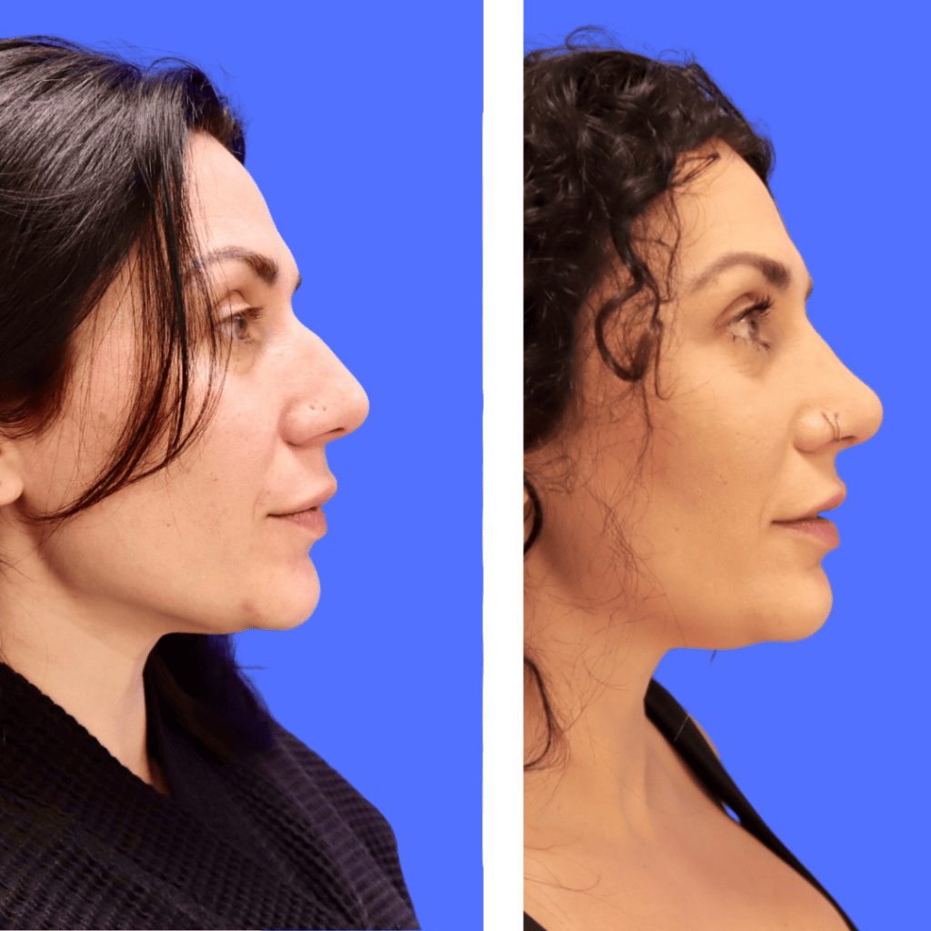 Before and After - Rhinoplasty