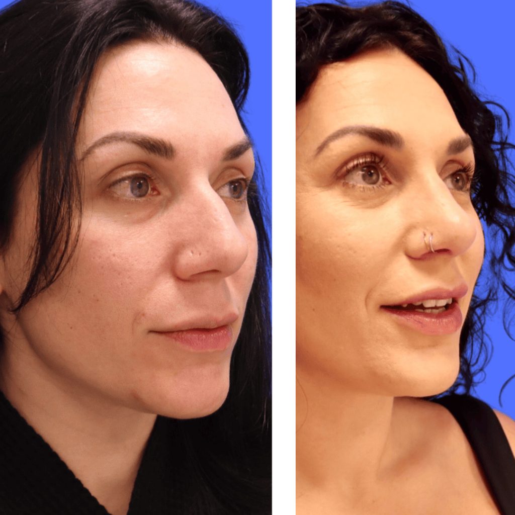 Before and After - Rhinoplasty