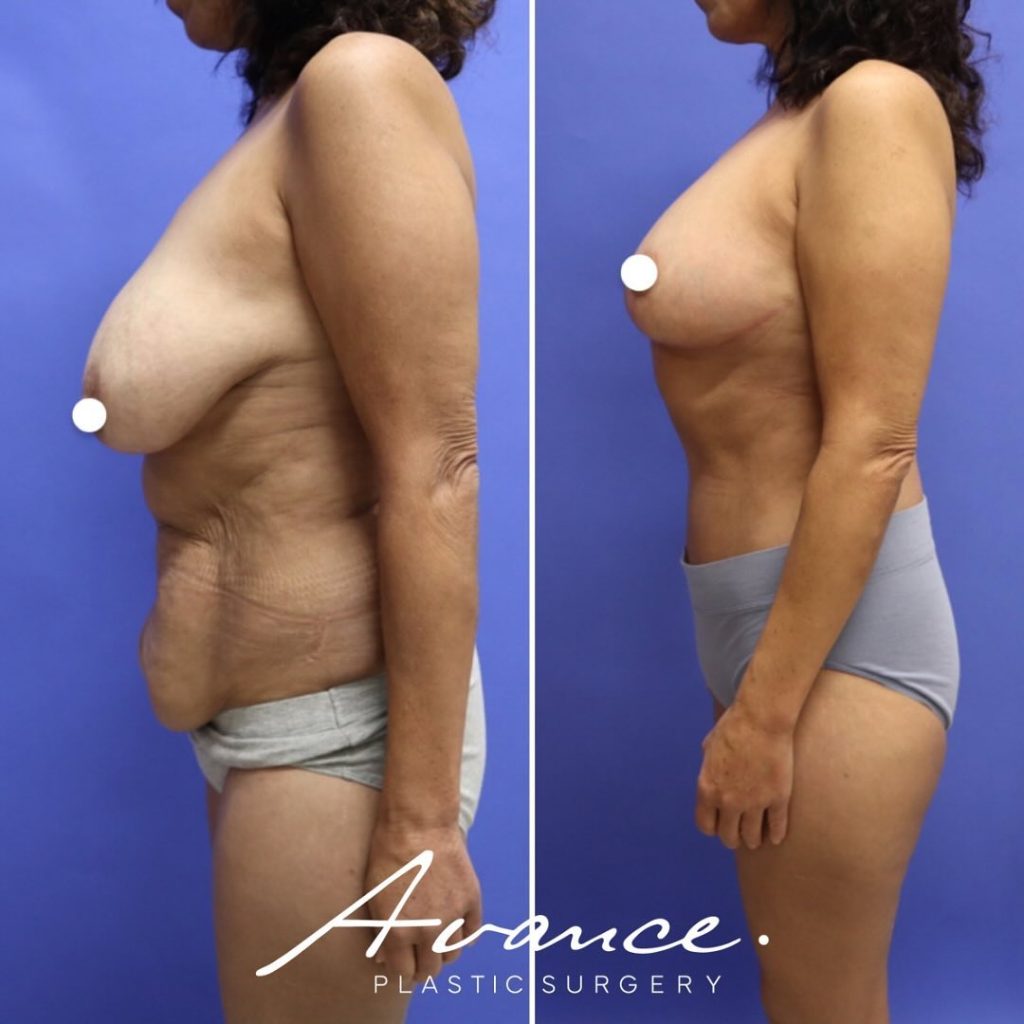 Before and After - Breast Lift