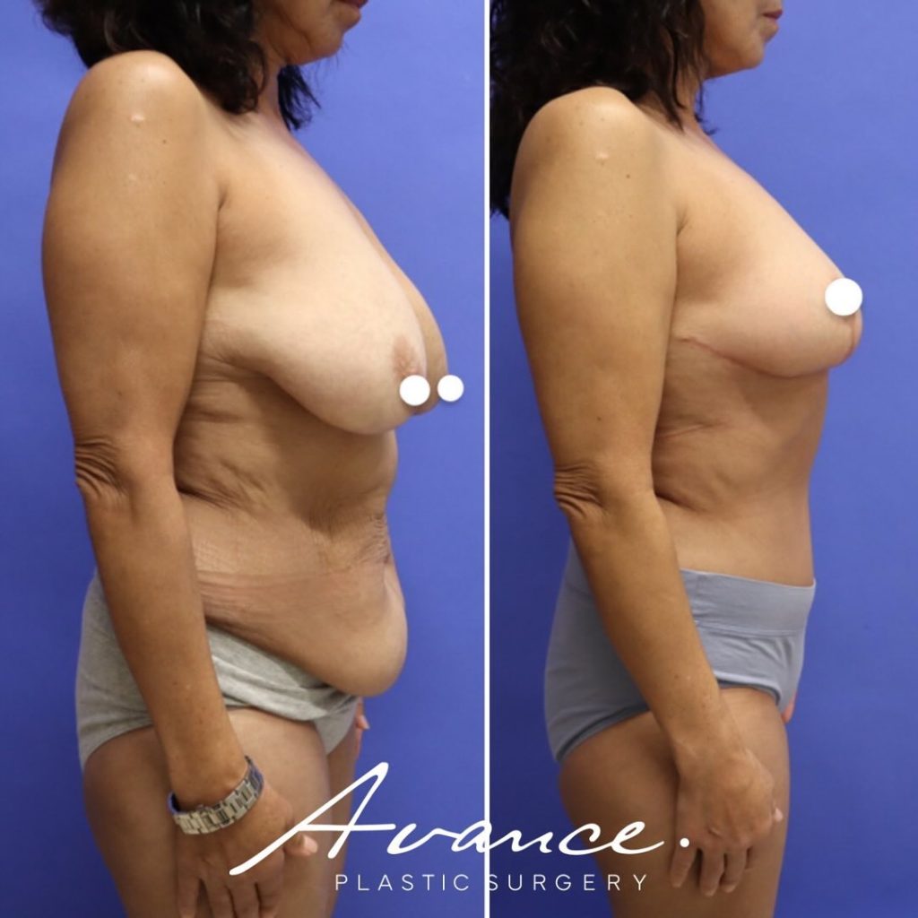 Before and After - Breast Lift