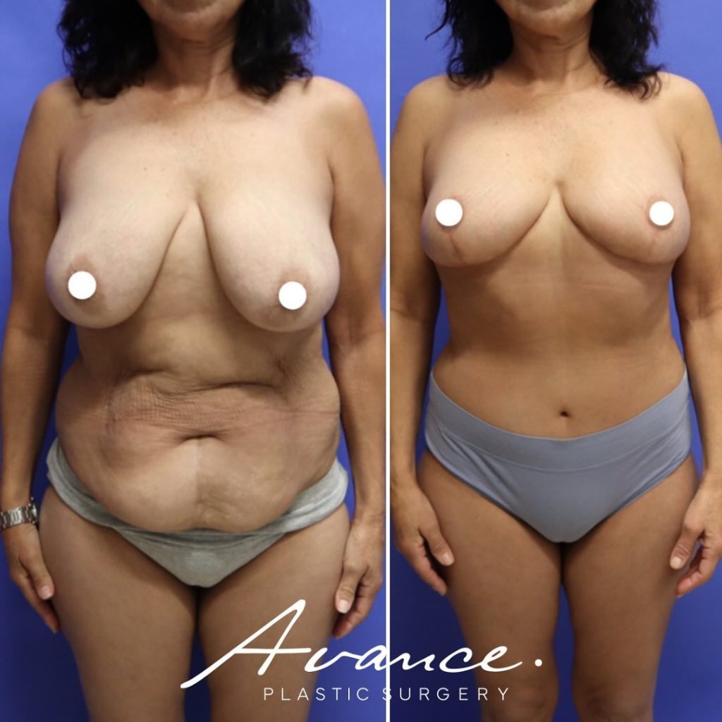 Before and After - Breast Lift