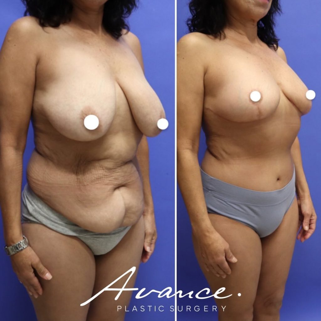 Before and After - Breast Lift