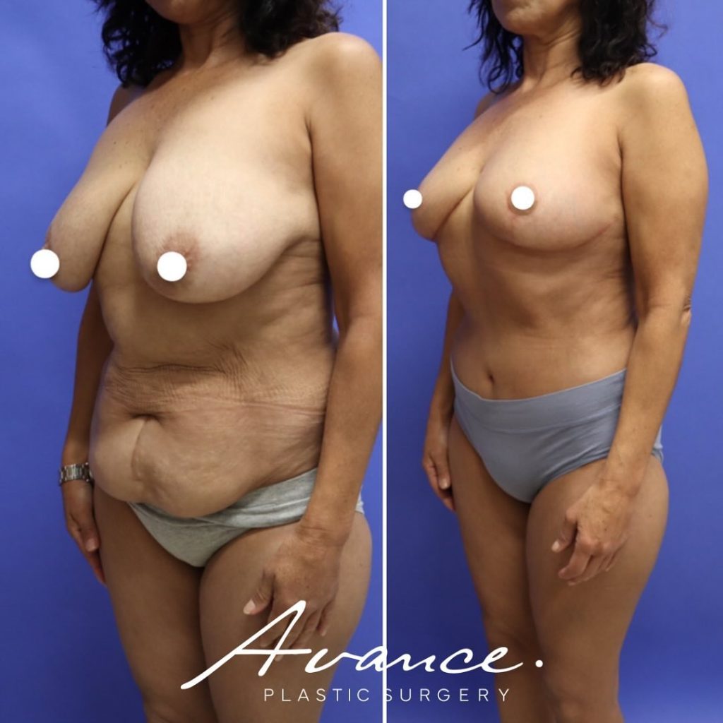 Before and After - Breast Lift