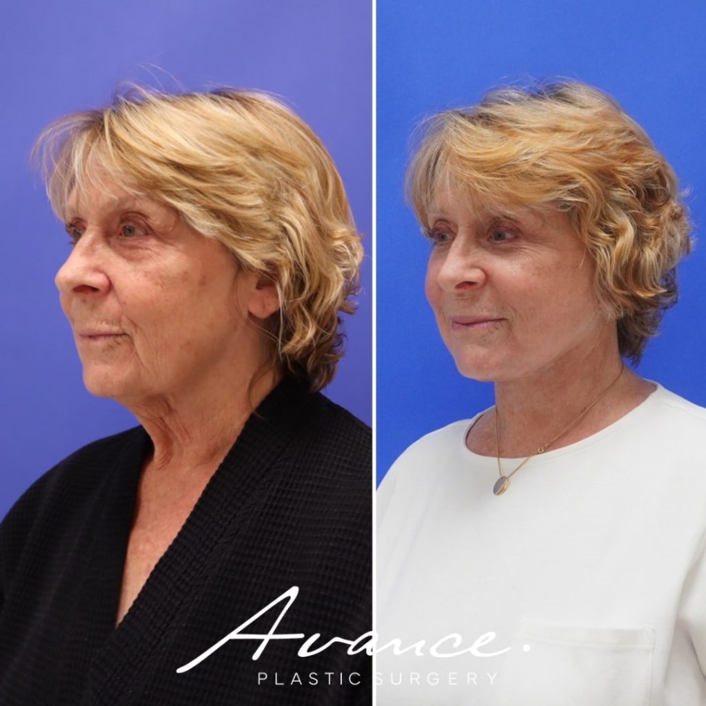 Before and After - Bleferoplastia inferior