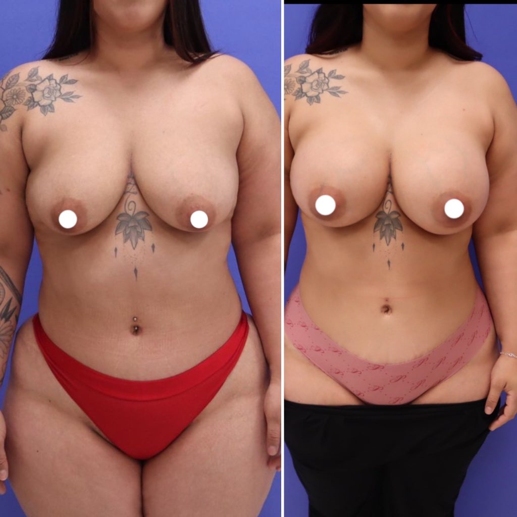 Before and After - Breast Augmentation