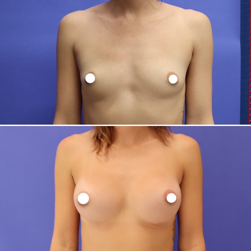 Before and After - Breast Augmentation