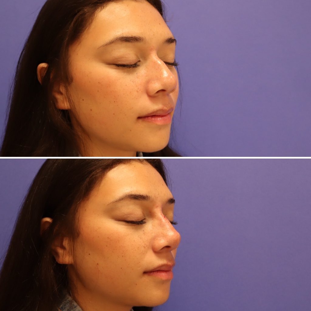 Before and After - Non-Surgical Rhinoplasty