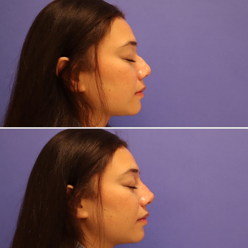 Before and After - Rinoplastia no quirúrgica