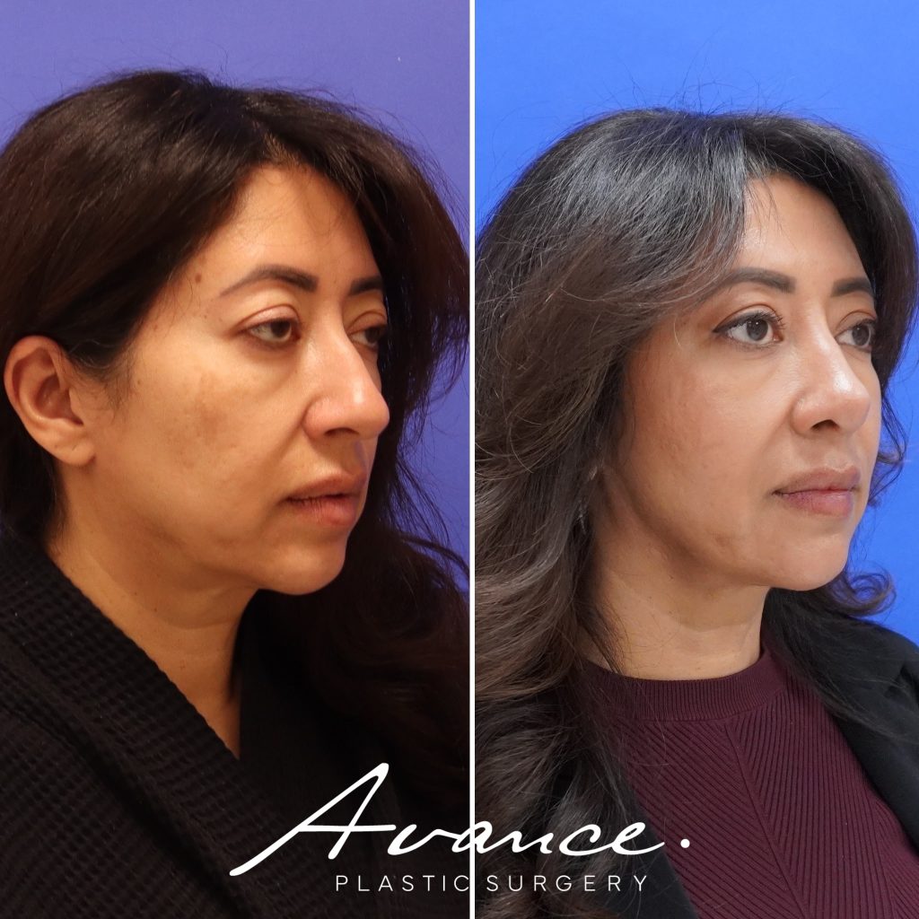 Before and After - Rinoplastia