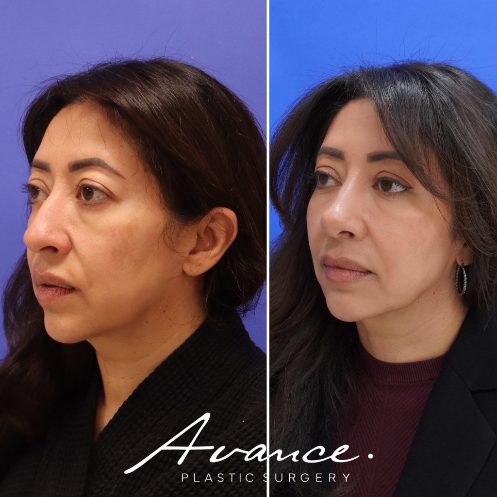 Before and After - Rhinoplasty