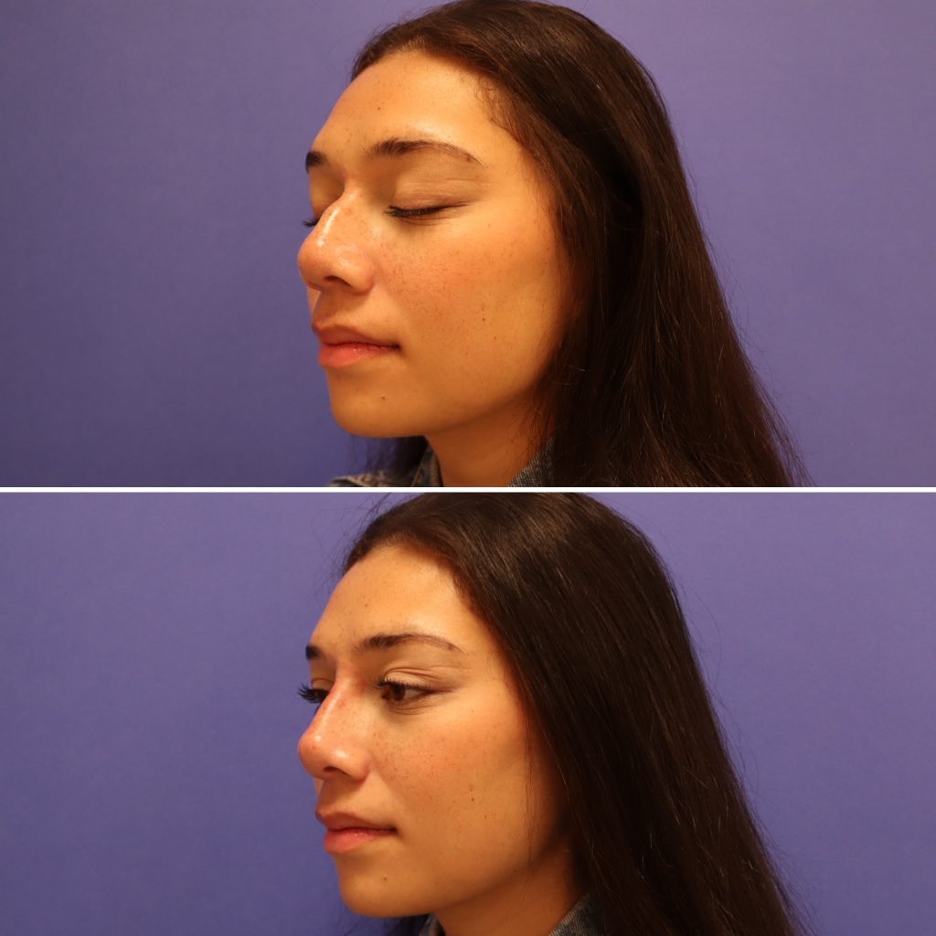 Before and After - Non-Surgical Rhinoplasty