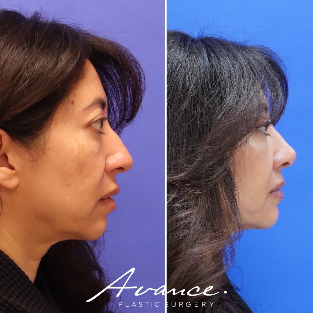 Before and After - Rhinoplasty