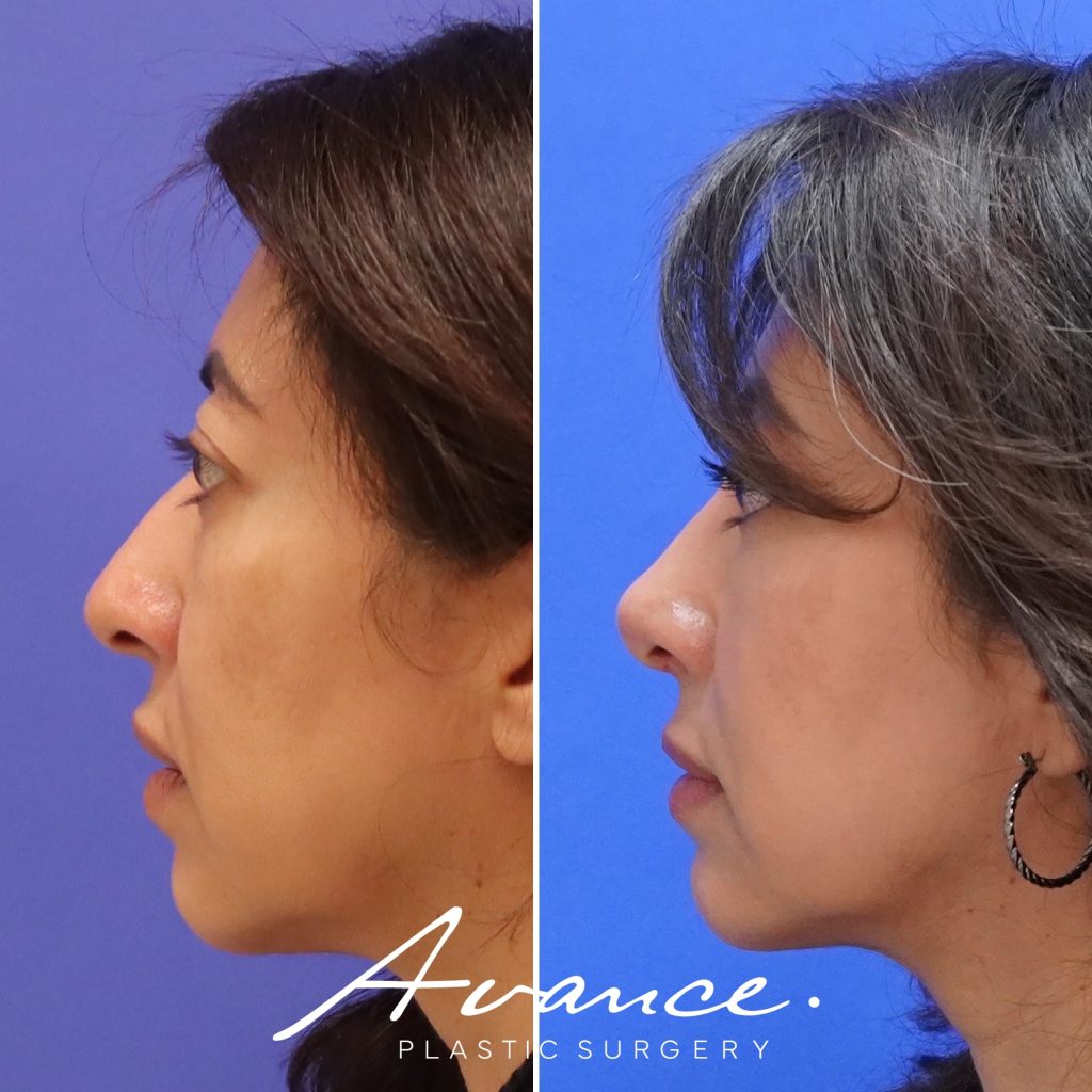 Before and After - Rhinoplasty