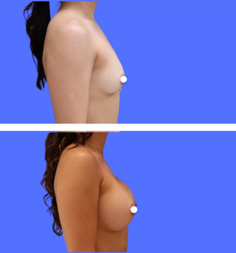 Before and After - Breast Augmentation